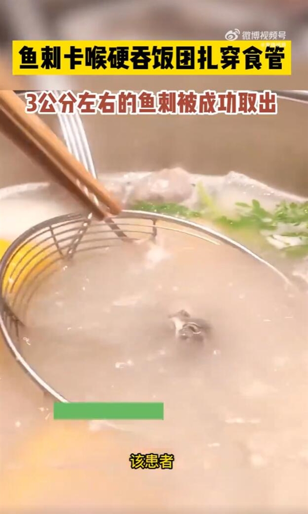 男子被魚刺卡喉硬吞飯團：結(jié)果扎穿食管